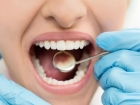Восстановление зубов фотопломбой (при утрате 30%)